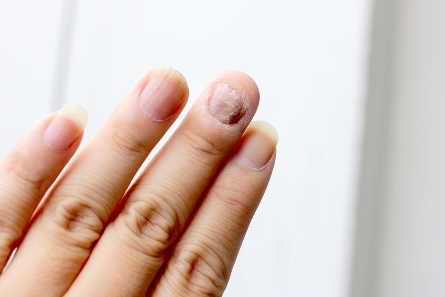 The Ultimate Solution for Nail Fungus