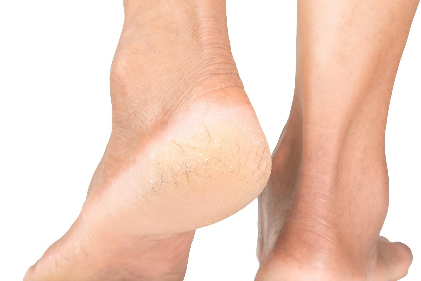 How to Heal Dry, Cracked Heels, According to the Dermatologist - Sakhiya  Skin Clinic